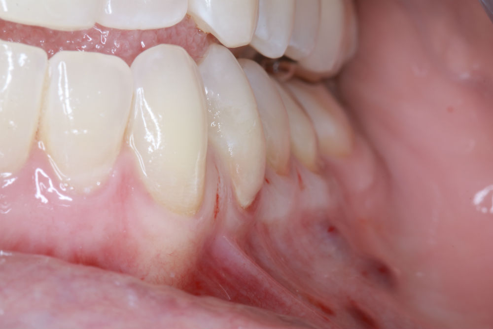 Gingival Graft Procedure