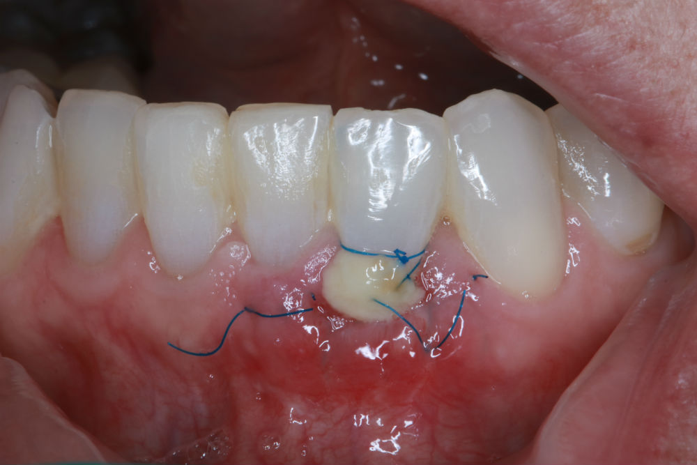 Gingival Graft Procedure