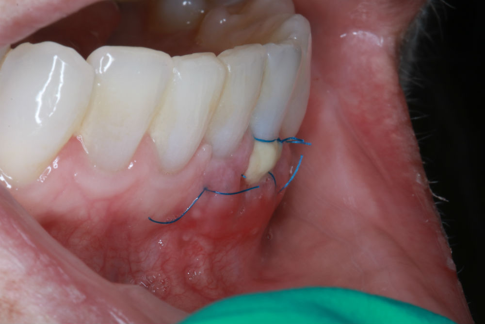 Gingival Graft Procedure